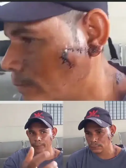 Hombre resulta con más de 40 puntos tras ser agredido en el rostro con un plato de espaguetis calientes por celos